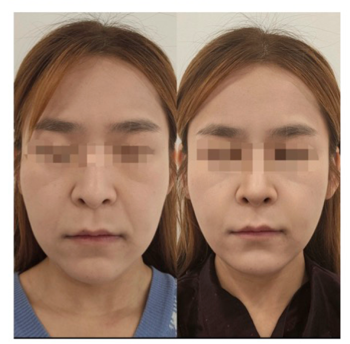 ピーチリフト施術前後の変化 Case 01 左Before 右After