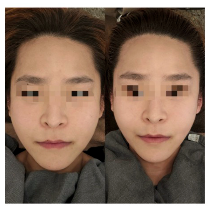 ピーチリフト施術前後の変化 Case 02 左Before 右After